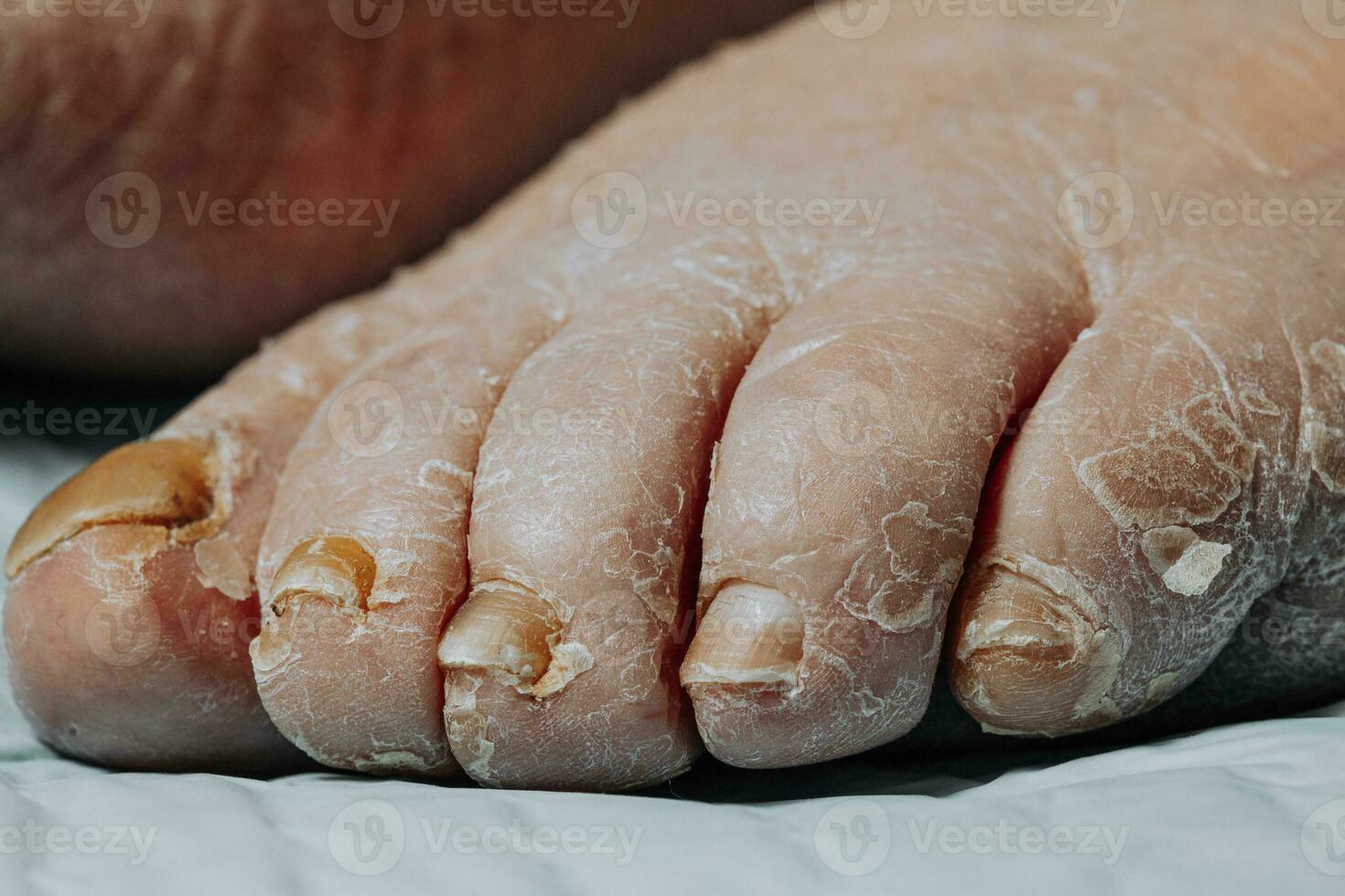på ett ben, de hud skalar av på grund av till eksem. gulning av de nagel tallrik. konsekvenser av diabetes i de äldre foto