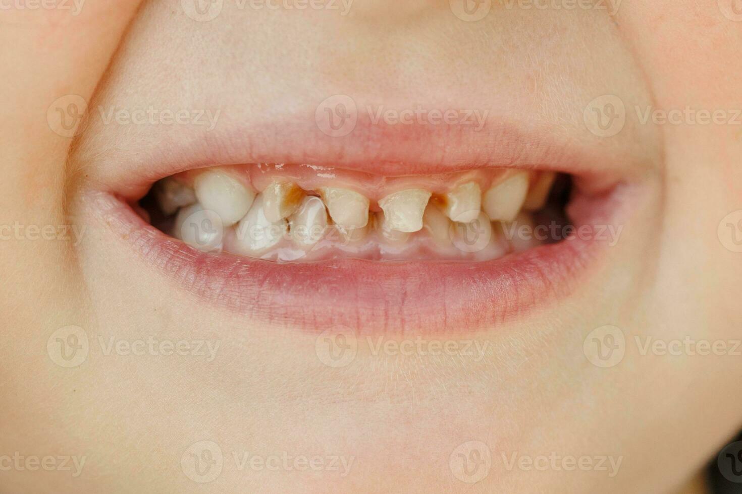 barns mjölk tänder med karies. närbild av ohälsosam mjölk tänder. dental medicin och sjukvård - patientens öppen mun som visar karies. barns tandläkare. foto