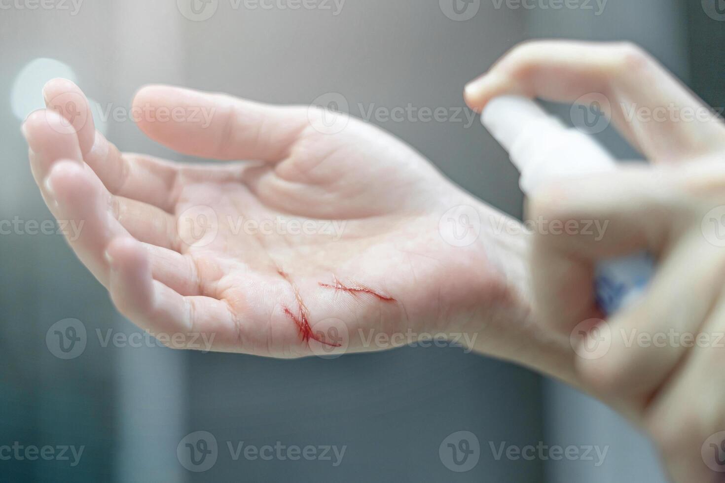 stänga upp sår i kvinnor hand och först hjälpa använder sig av förbi alkohol spray i Hem grundläggande bakterie förebyggande foto