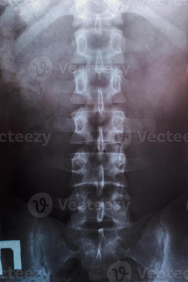 x stråle av de länd- ryggrad, ryggrad på röntgen foto