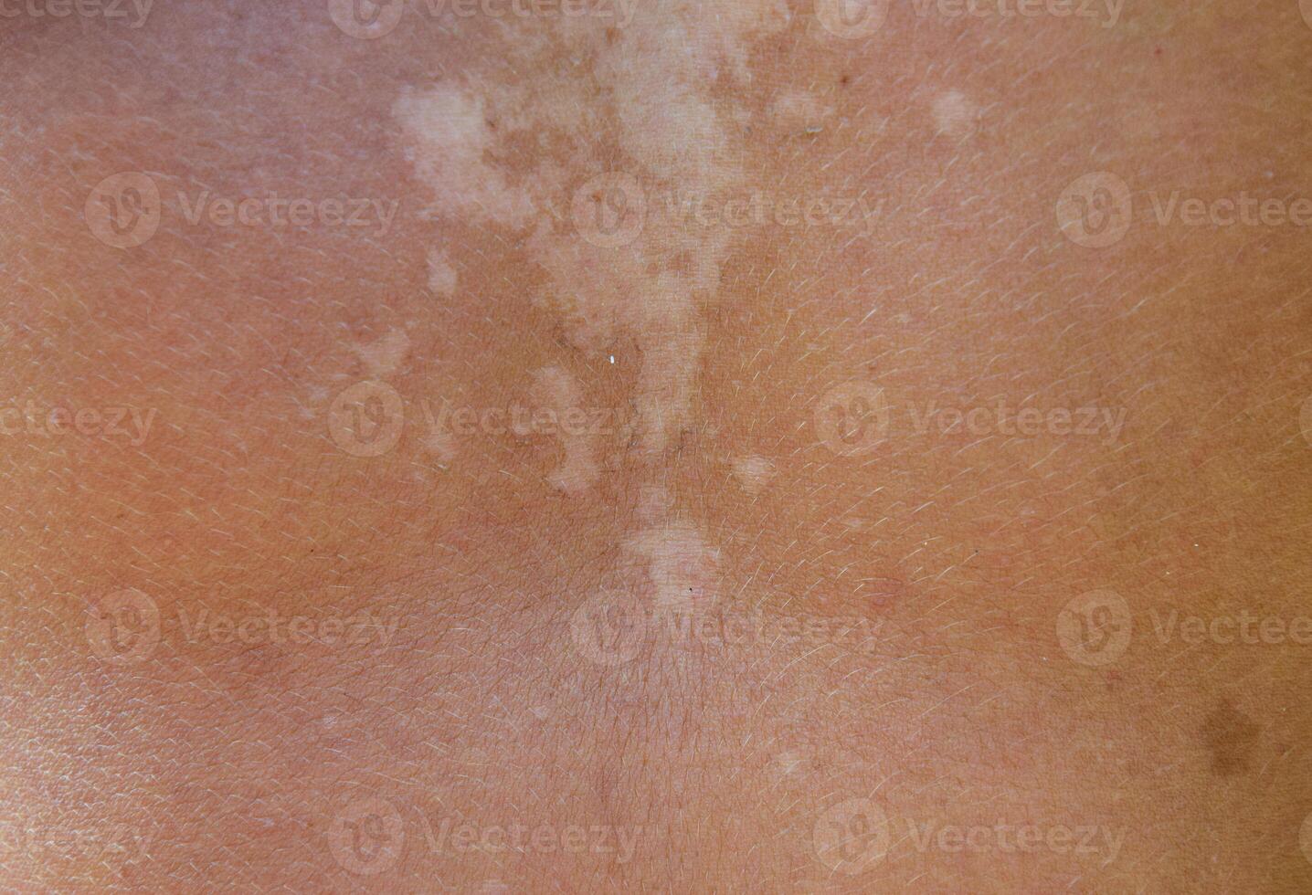 solbränna på de hud av de tillbaka. exfoliering, hud skalar av. farlig Sol solbränna foto