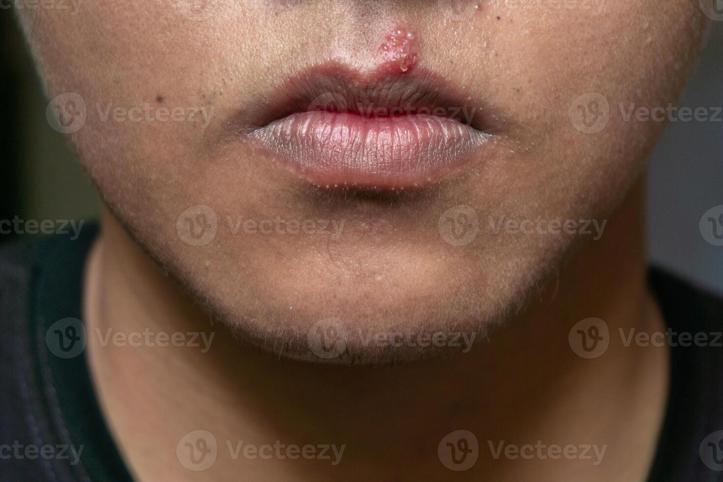 herpes virus och infektion behandling. män mun påverkade förbi herpes blåsor foto