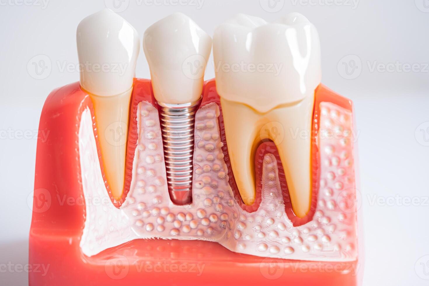 dental implantera, artificiell tand rötter in i käke, rot kanal av dental behandling, gummi sjukdom, tänder modell för tandläkare studerar handla om tandvård. foto