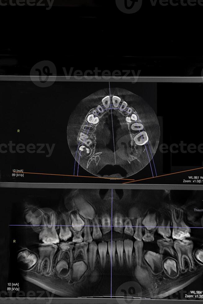 ct bild av de tänder av en 9-åring barn, med bebis tänder, i annorlunda projektioner. cbct av två käftar. foto