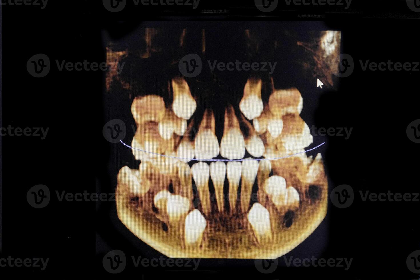 ct bild av de tänder av en 9-åring barn, med bebis tänder, i annorlunda projektioner. cbct av två käftar. foto