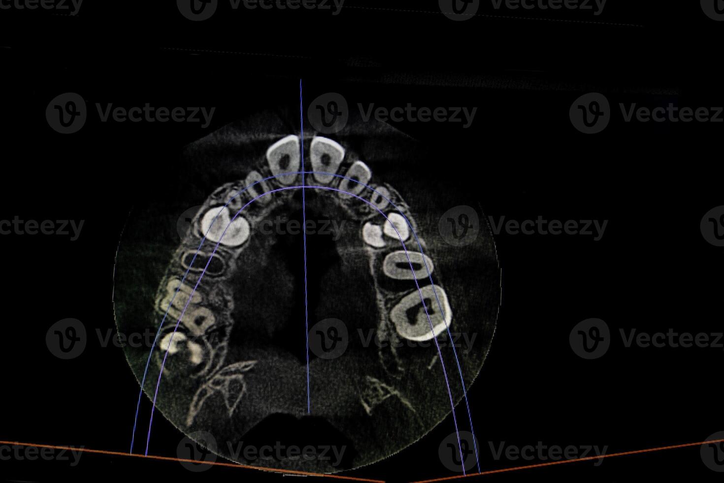 ct bild av de tänder av en 9-åring barn, med bebis tänder, i annorlunda projektioner. cbct av två käftar. foto