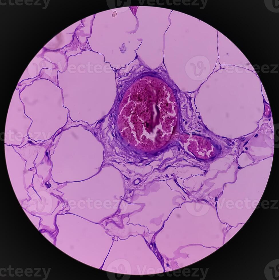 lipom på fransyska, godartad tillväxt av fet vävnad, godartad neoplasm, adipocyter, delvis kapslade tumör, 40x mikroskopisk se. foto