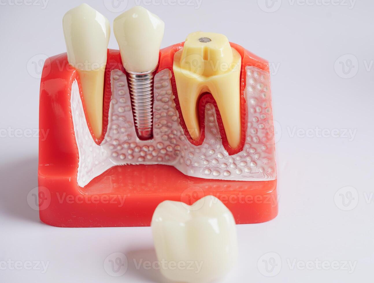 dental implantera, artificiell tand rötter in i käke, rot kanal av dental behandling, gummi sjukdom, tänder modell för tandläkare studerar handla om tandvård. foto