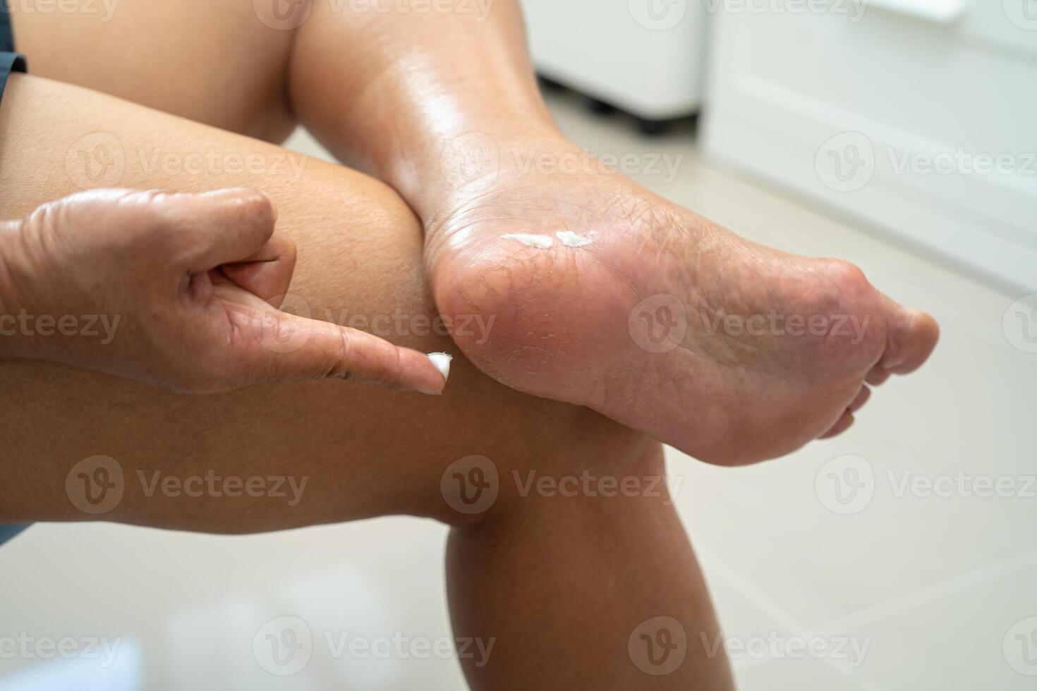 asiatisk kvinna vård fötter med knäckt och torr häl hud grädde på Hem. foto