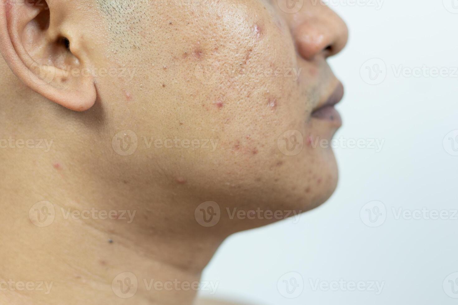 hud problem. problem av inflammerad acne på de ansikte. inflammerad acne består av svullnad, rodnad, och porer den där är allvarligt igensatt med bakterie, olja, och död- hud celler. foto