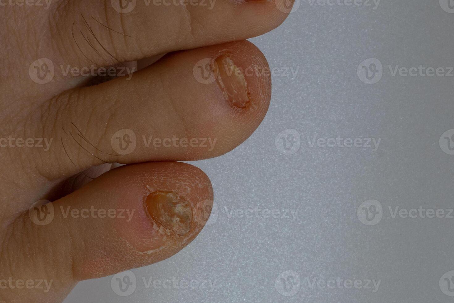 svamp nagel infektion onykomykos torr grov hud av de ben foto