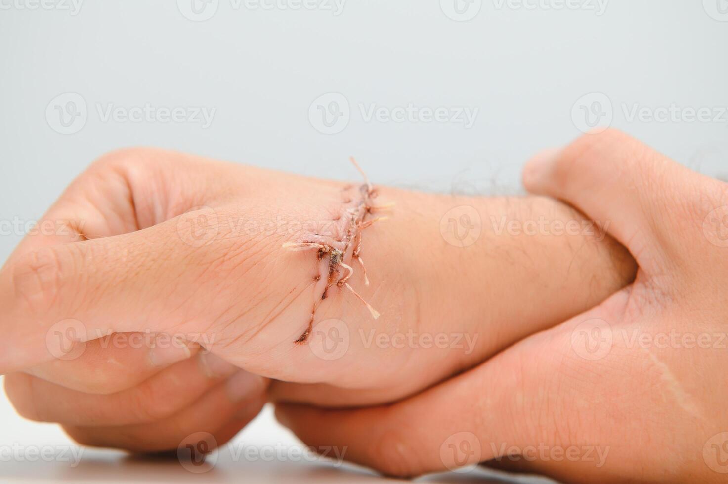 sutur sår på hand, smärta av olycka begrepp foto