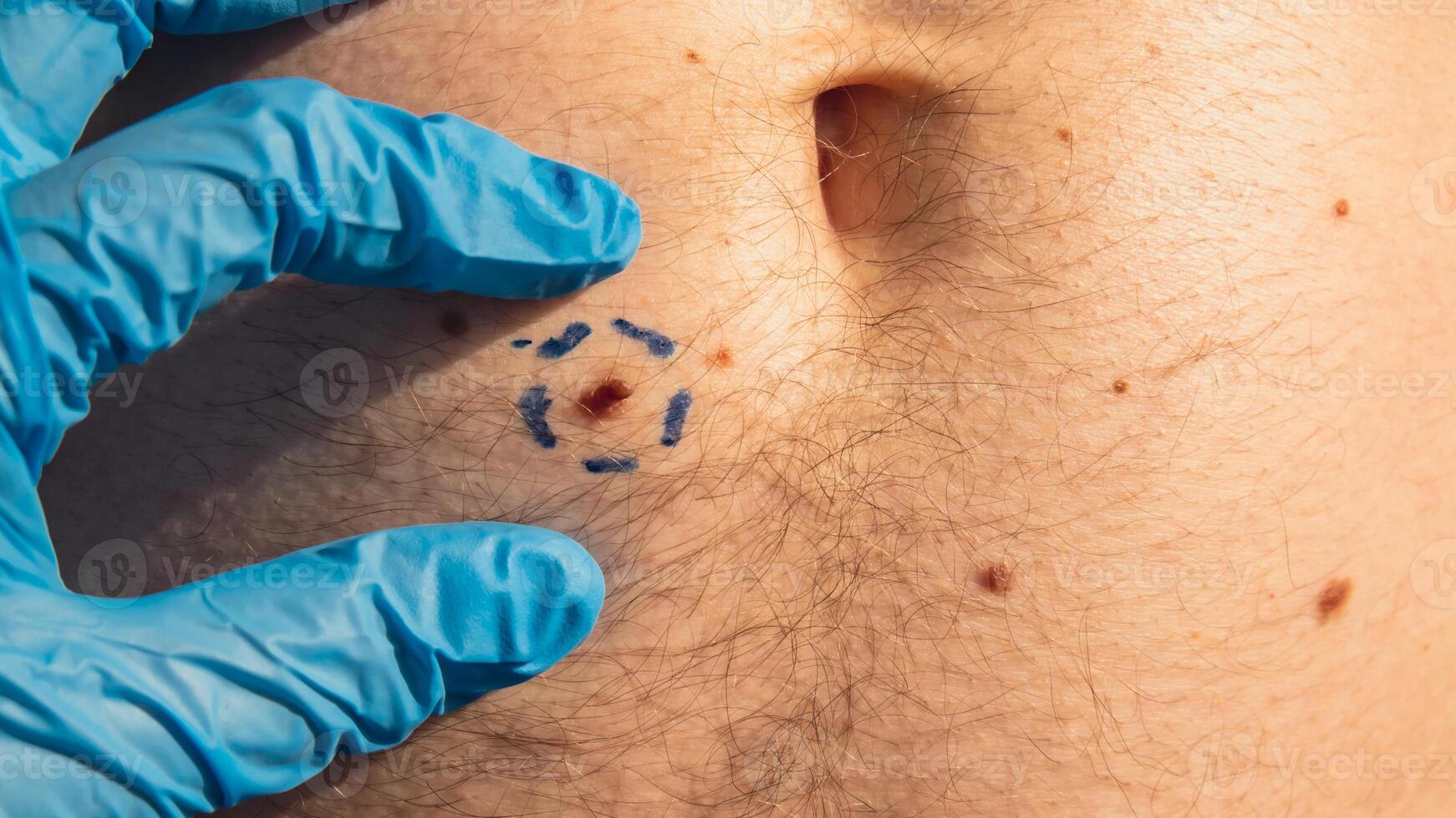 läkare i medicinsk handskar måla rader runt om manlig födelsemärken. framställning procedur för medicinsk kirurgi. laser hud taggar avlägsnande. förebyggande av melanom och nevus examen foto