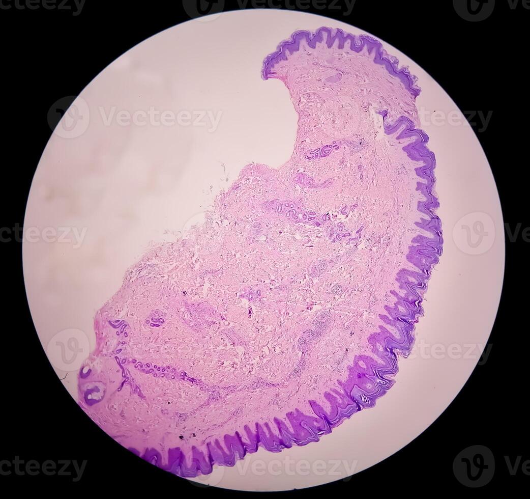 histologisk mikrofotografi. prurigo nodularis eller pn är en kronisk oordning av de hud. foto