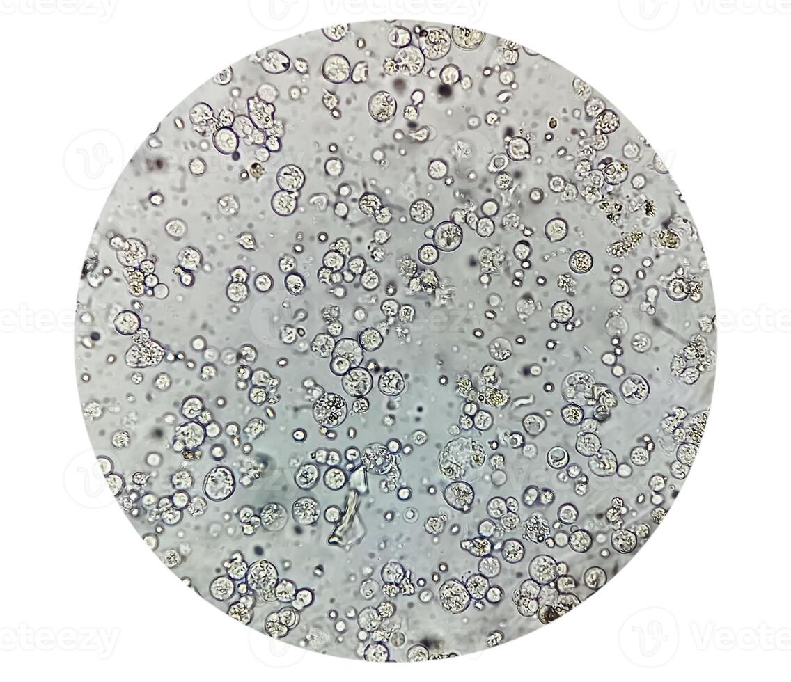 mikrofotografi av urinprov som visar massor pus celler, urin- tarmkanalen infektion. foto