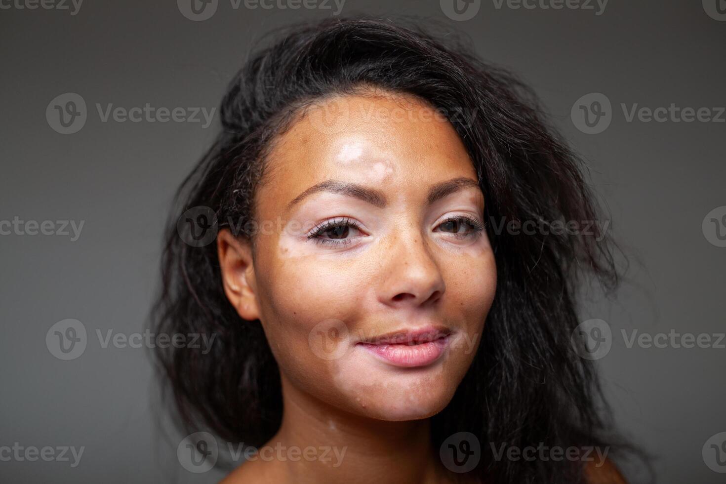 Lycklig svart kvinna med vitiligo pigmentering hud problem foto