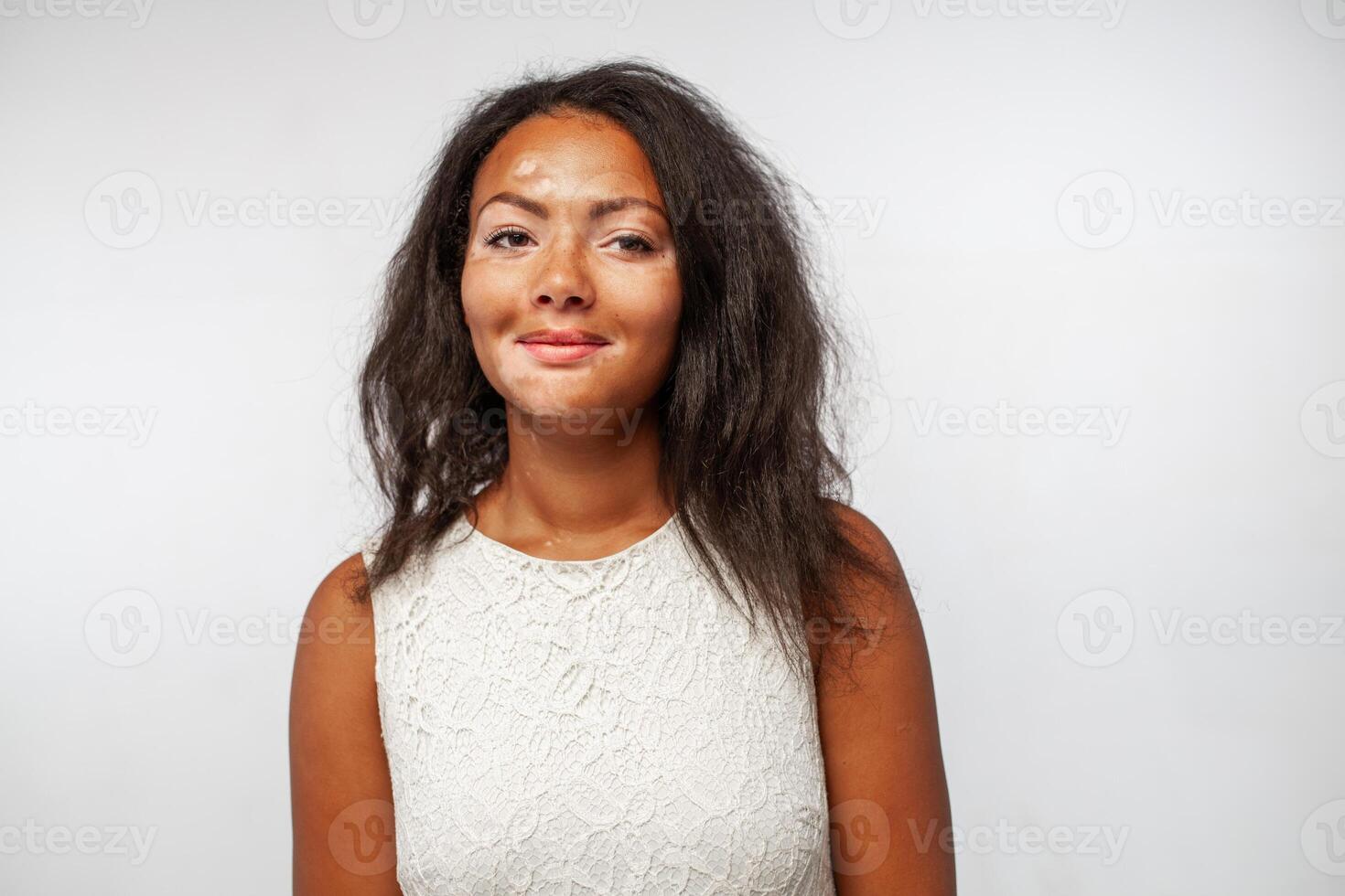 Lycklig svart kvinna med hud problem vitiligo sjukdom i vit studio foto