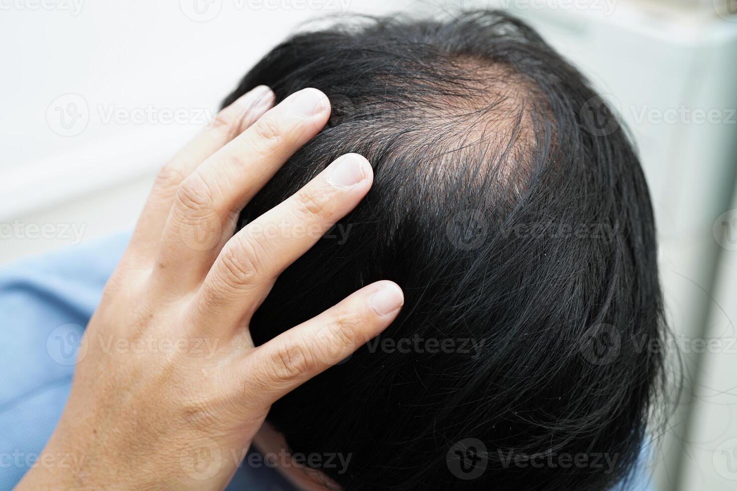 läkare Rör djärv huvud i man, hår förlust behandling hälsa problem. foto