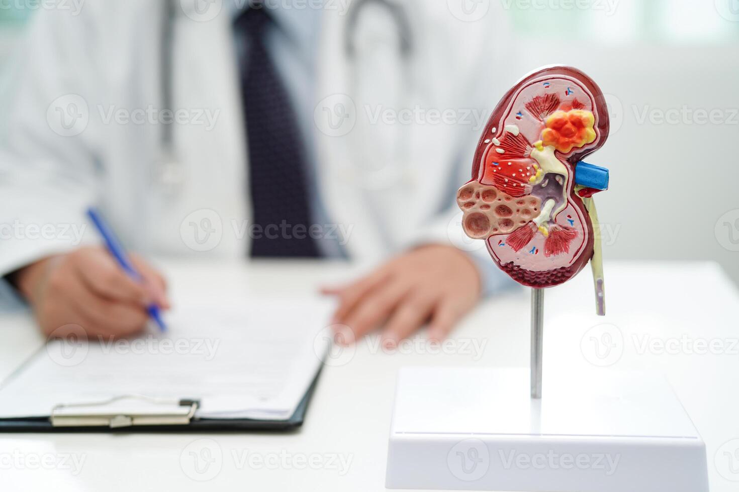 kronisk njure sjukdom, läkare med modell för behandling urin- systemet, urologi, beräknad glomerulär filtrering Betygsätta egfr. foto