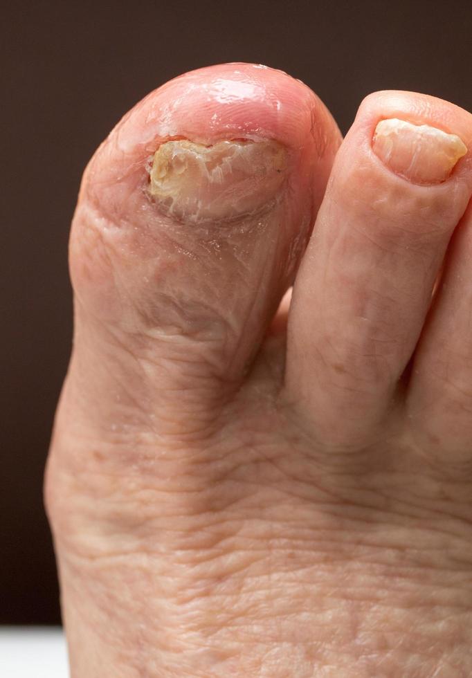 infekterad stortå med inåtväxande tånagel, fjällande, torr hud och sprickor foto