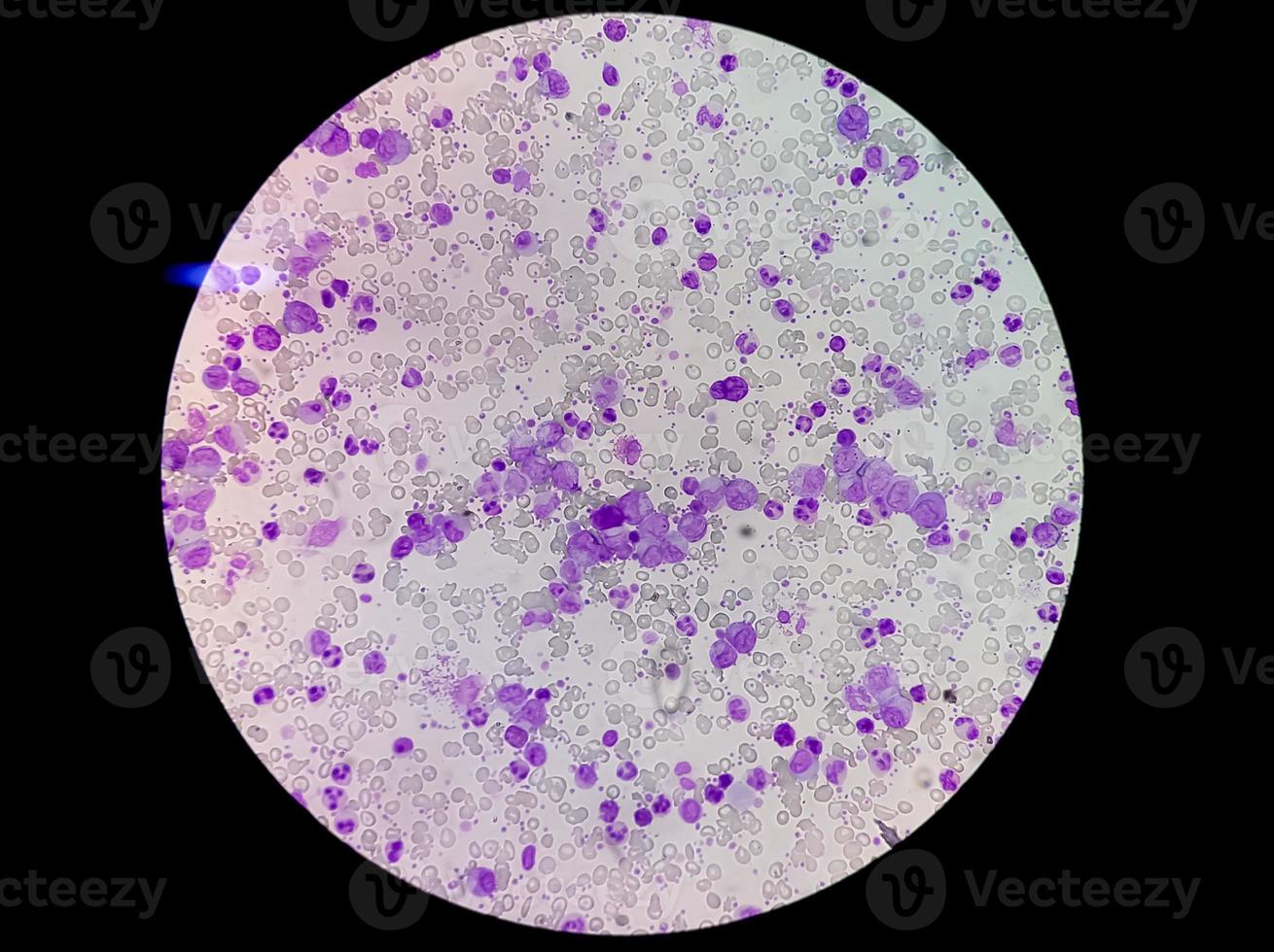 essentiell trombocytosblodprov som visar onormalt hög volym av blodplättar och vita blodkroppar analyseras med mikroskop. essentiell trombocytemi eller trombocytopeni. mikroskopisk bild av objektglaset. foto