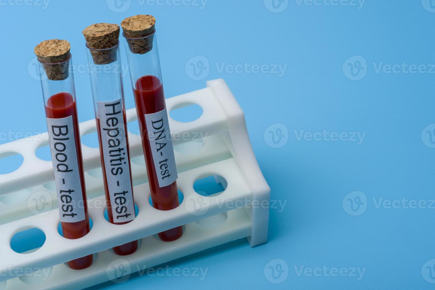 blodprov hepatittest och dna-test in vitro. foto