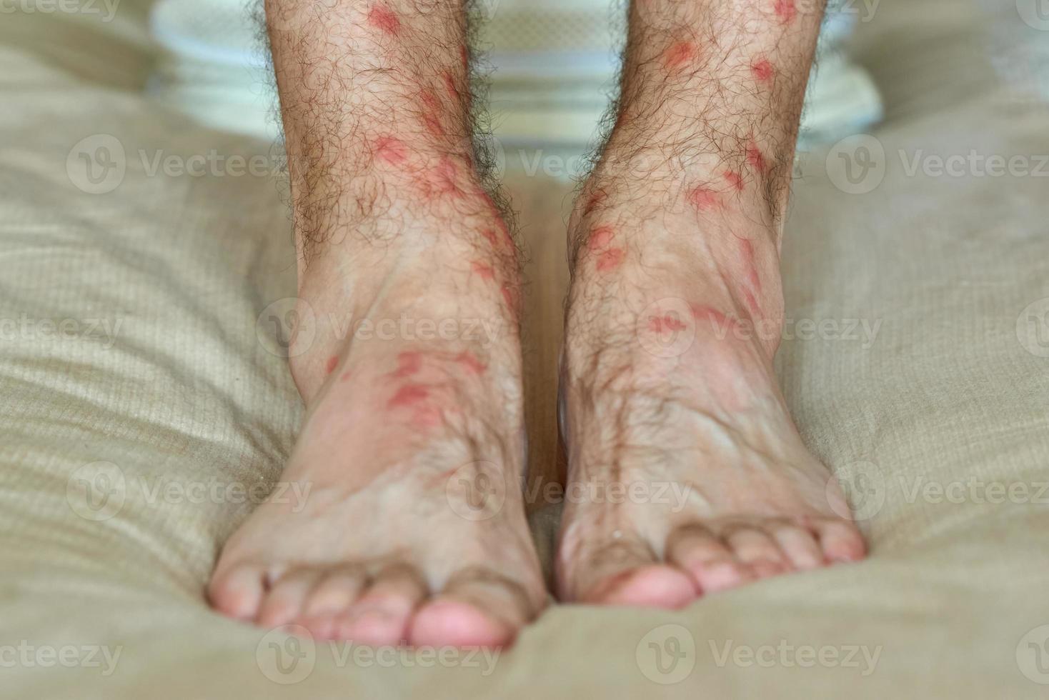 manliga ben med många röda fläckar och ärr från insektsbett. foto