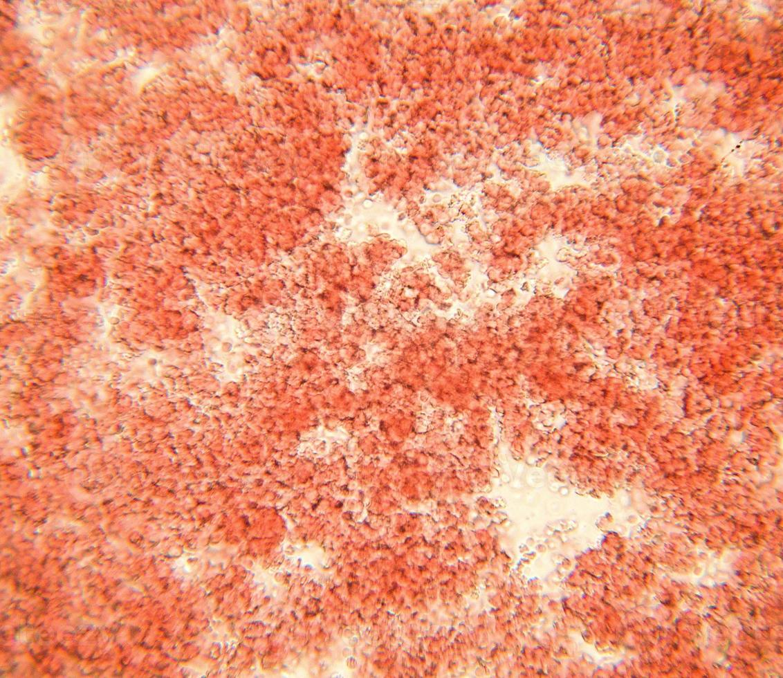 blodutstryk under mikroskop presentera neutrofiler och röda blodkroppar. fotomikrosnitt med hög förstoring med ljusmikroskop foto