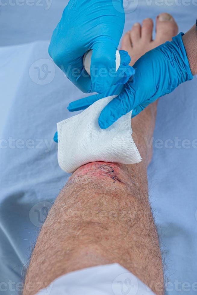 sjuksköterska vård nyblodiga skada sår på skenbenet av benet. stickstygn för att hålla snittet. foto