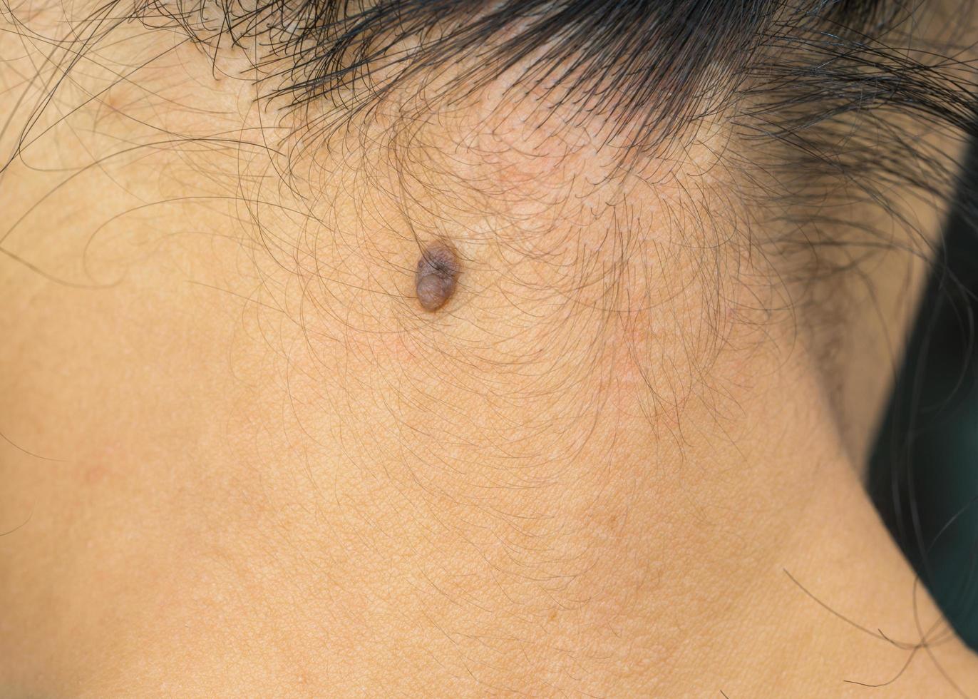 svart mullvad på baksidan av nacken huden hos asiatisk kvinna behöver co2-laser för borttagning. foto