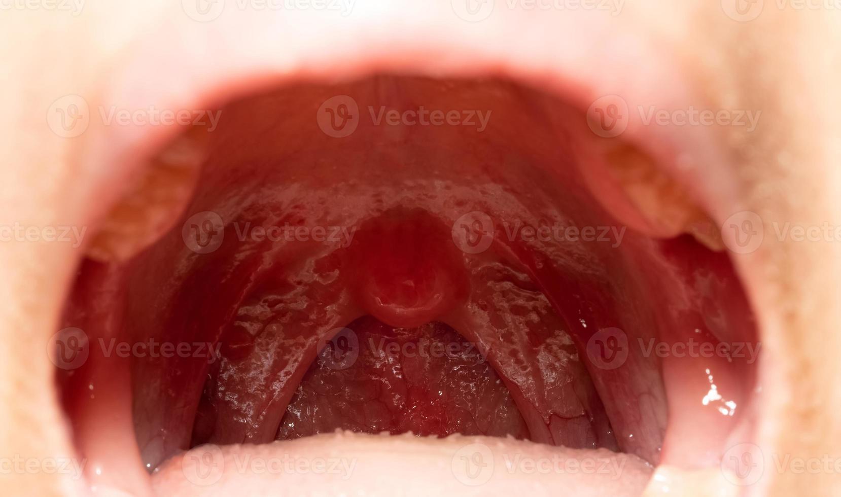 ont i halsen med svullen hals. närbild öppen mun med svullnad i bakre svalgväggen och uvula och tonsiller. influensafolliklar i bakre svalgväggen. övre luftvägarna. foto