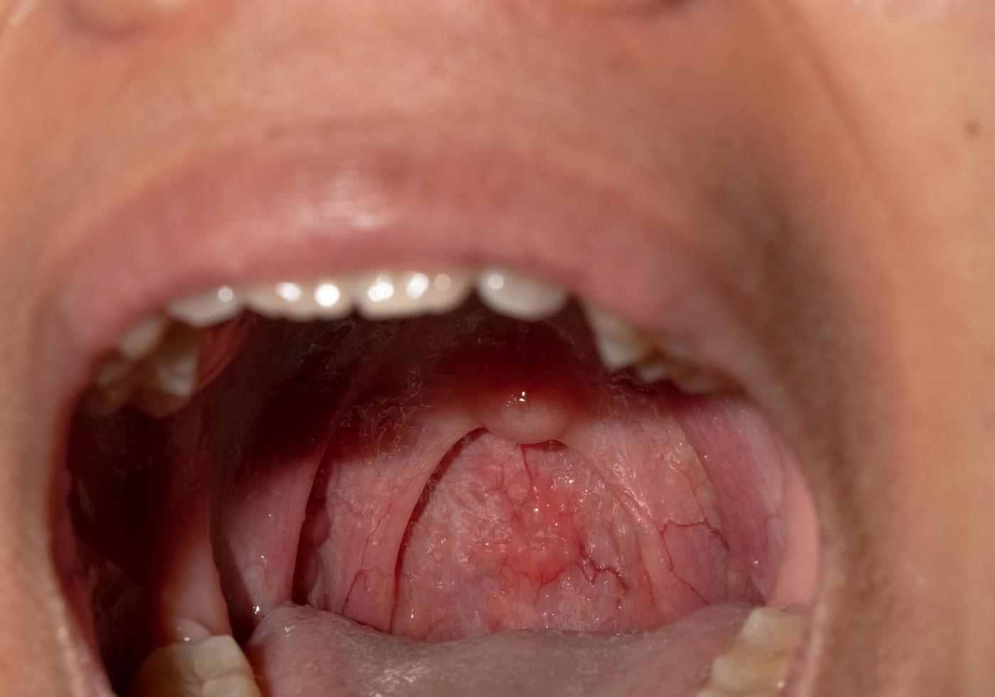 ont i halsen med svullen hals. närbild öppen mun med svullnad i bakre svalgväggen och uvula och tonsiller. influensafolliklar i bakre svalgväggen. övre luftvägarna. foto