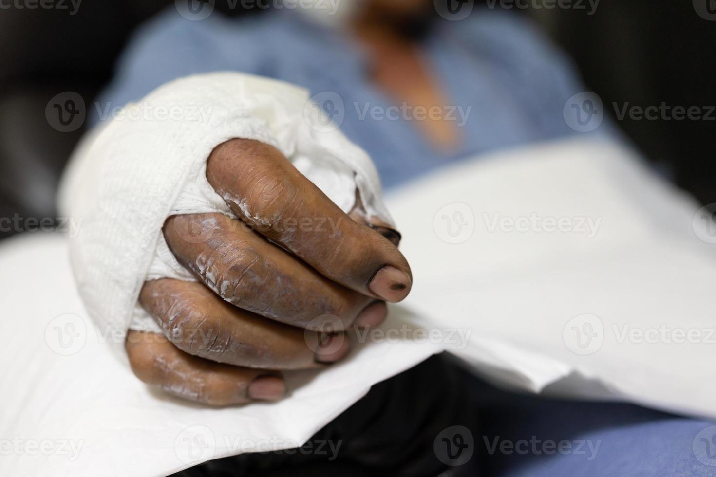 patient med brännskador på sjukhuset. applicera bandage på patientens armbrännsår. foto