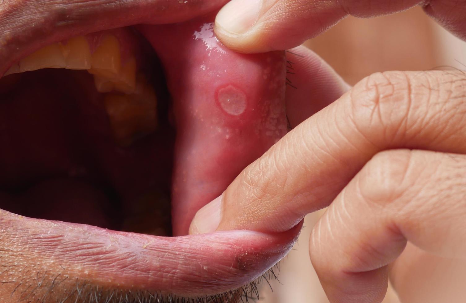 munsår och andra orsaker till orofacial ömhet och smärta foto