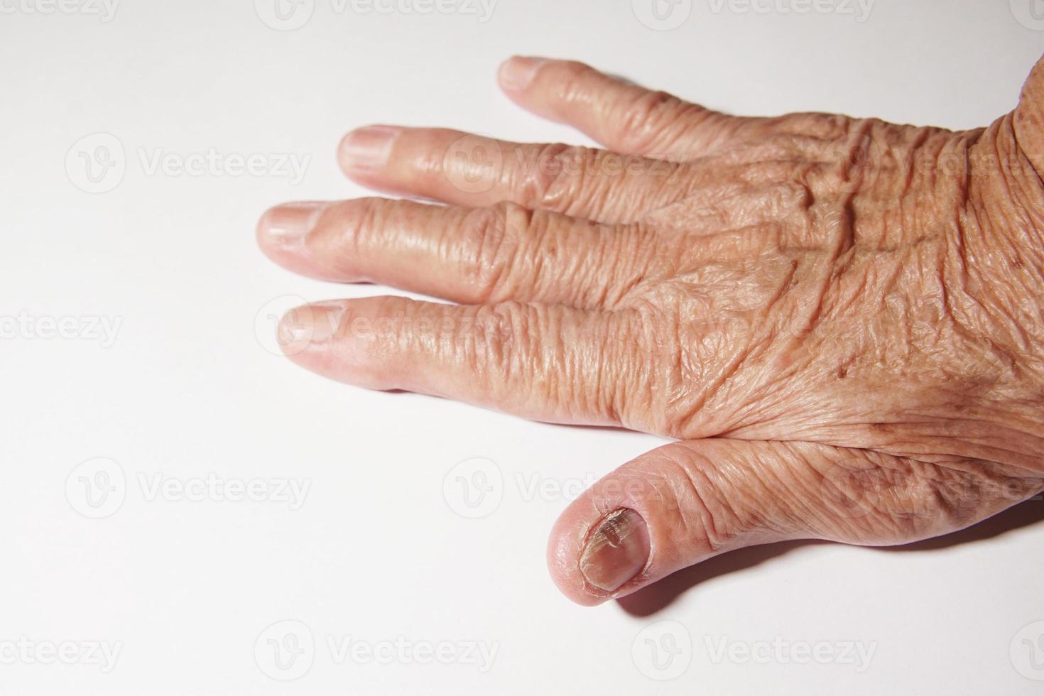 nagel av en äldre kvinna infekterad med svampinfektion. foto