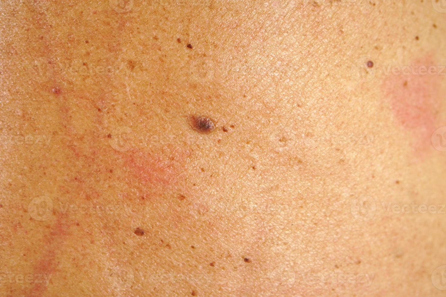 mullvadar på baksidan av mänsklig hud foto