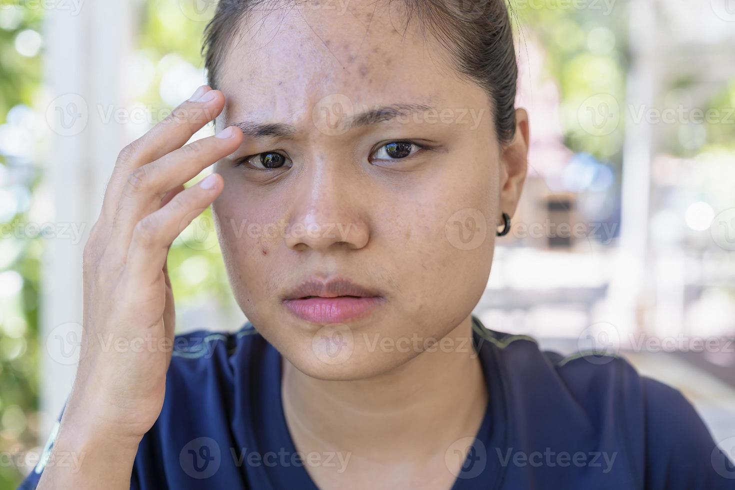 ung asiatisk kvinna oroar sig för hennes ansikte när hon har problem med huden i ansiktet i en naturlig bakgrund. problem med akne och ärr på den kvinnliga huden. problem hudvård och hälsokoncept. foto