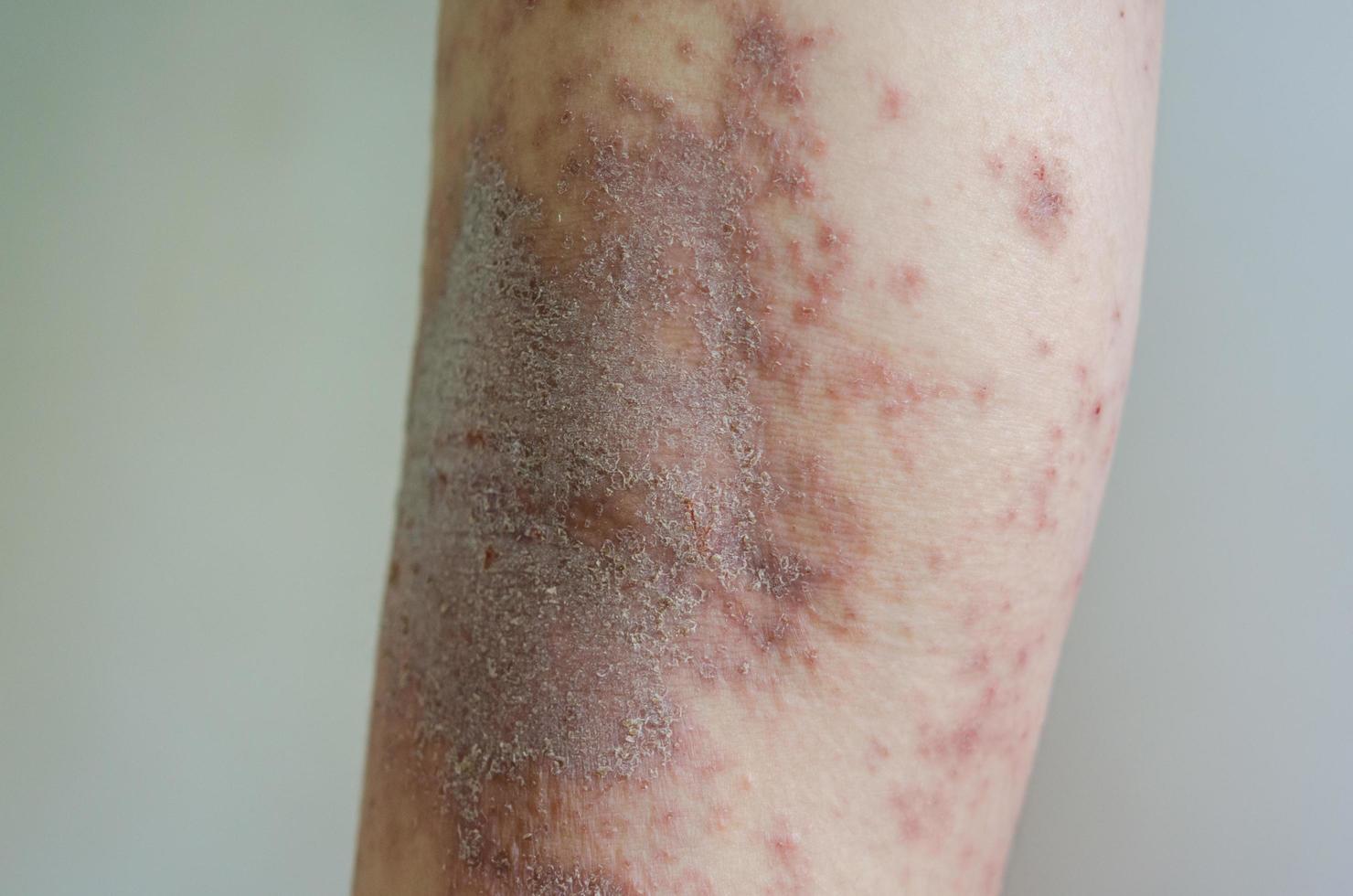 röda utslag flicka hudsjukdom orsakad av allergier mot droger, mat, kemikalier, dåligt immunförsvar i lymfan. foto