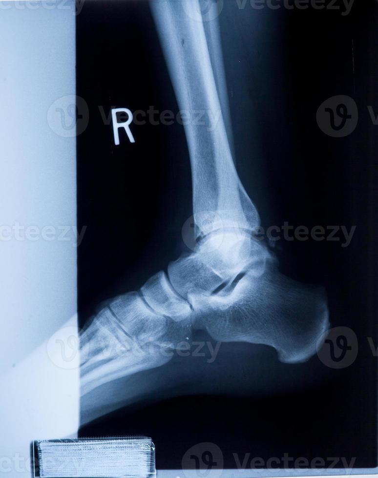 fotled och knäledsmärta mänsklig röntgen-mri-film foto