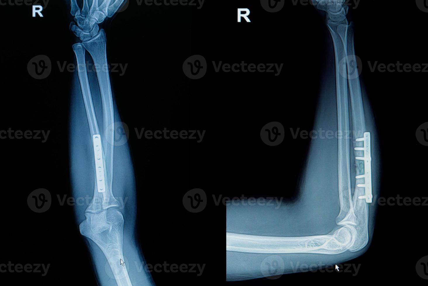 film röntgenhandledsbrott foto