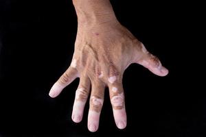 quadrichrome vitiligo foto