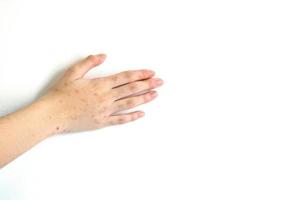 behandling av atopisk dermatit en infektion och klåda på en flickas hand involverar administrering av medicin. foto
