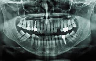 ortopantomografi panoramabild röntgenbild av tänder foto