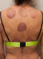 en kvinna som fick koppningsterapi på ryggen mot smärta foto