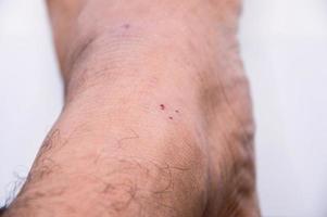 röda fotsår inflammation i såret vit bakgrund koncept läkning foto