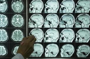 en hand som pekar på hjärnans MRI-bilder foto