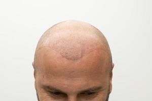 man efter hår implantera terapi foto