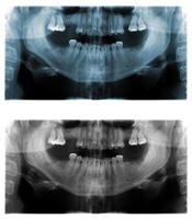 panorama- dental röntgen bilder foto