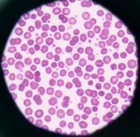 onormala röda blodceller stjärna form medicinsk bakgrund. foto