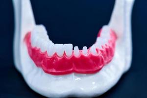 tand implantera och krona installation bearbeta foto